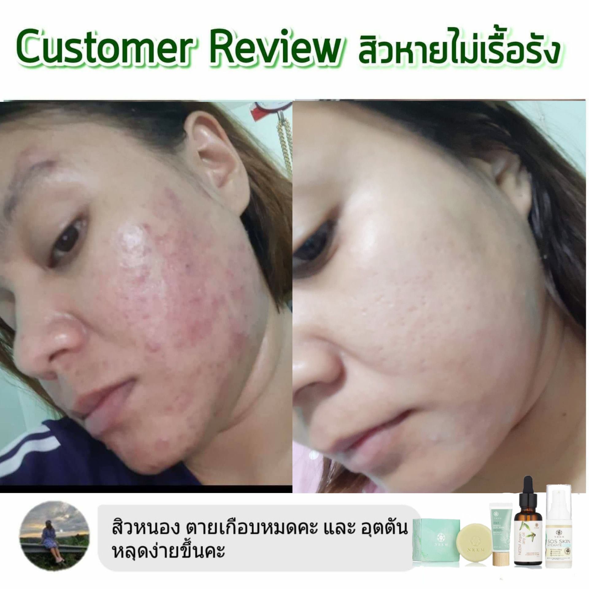 SOS Skin Hydrate Acne+ เซรั่มลดการอักเสบของสิว หน้าใสไร้สิว 20 g.