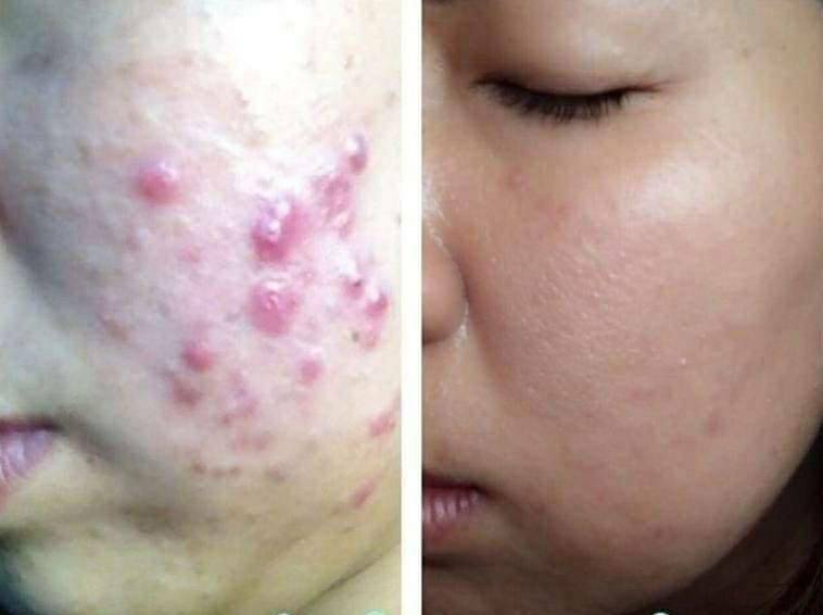 SOS Skin Hydrate Acne+ เซรั่มลดการอักเสบของสิว หน้าใสไร้สิว 20 g.