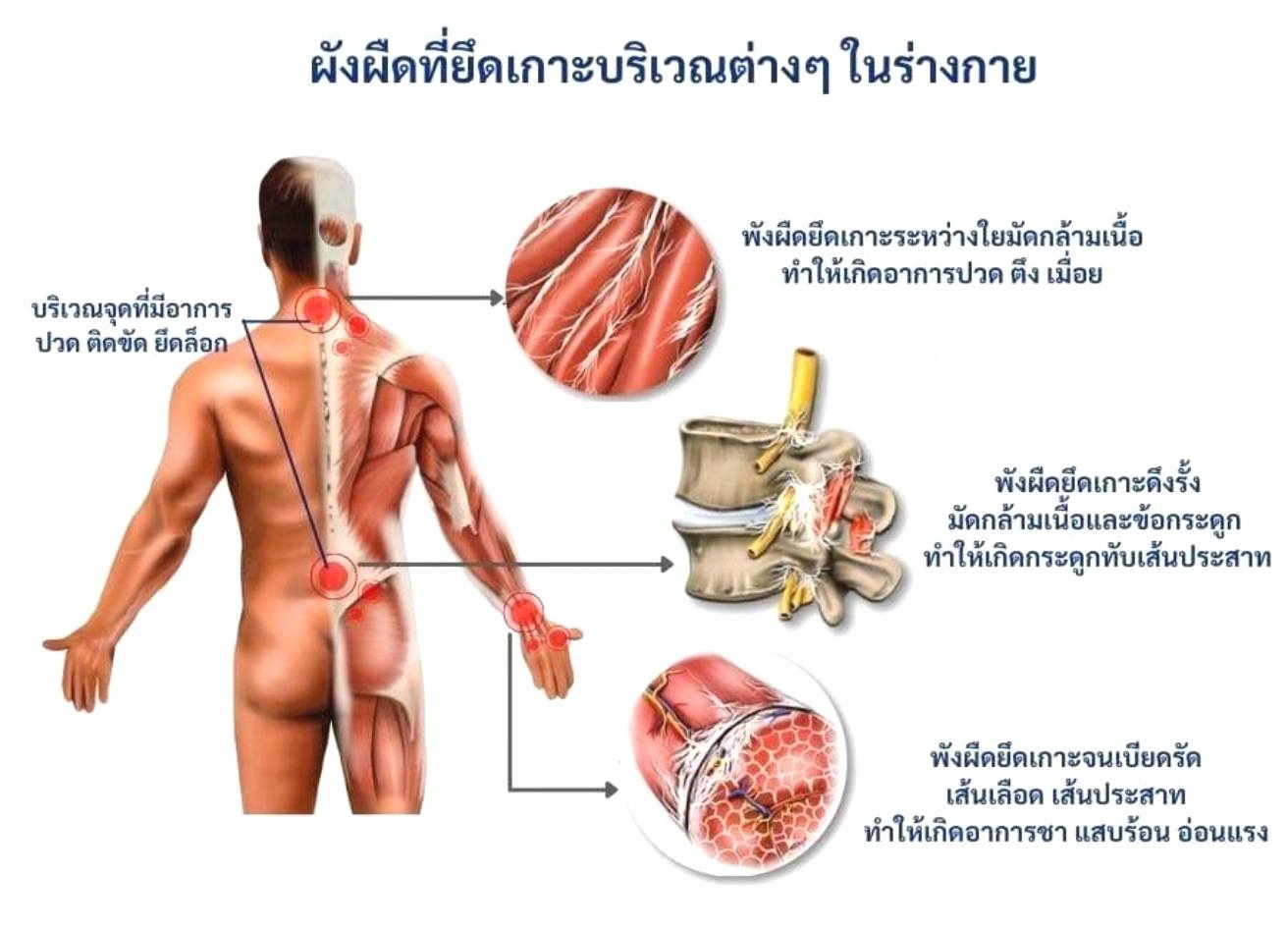 1 hrs Massage catching / นวดจับเส้น 👍นวดแก้อาการ 📌นวดจับเส้น 📌เอ็นเข้าสะบัก📌ไหล่ติด📌ปวดหลัง📌ชา📌ปวดขา📌ปวดสลักเพชร📌ท้องอืด📌ไมเกรน📌คอตกหมอน 📌หมอนรองกระดูกทับเส้นป