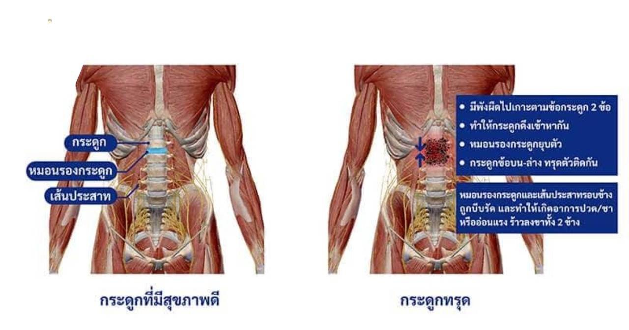 1 hrs Massage catching / นวดจับเส้น 👍นวดแก้อาการ 📌นวดจับเส้น 📌เอ็นเข้าสะบัก📌ไหล่ติด📌ปวดหลัง📌ชา📌ปวดขา📌ปวดสลักเพชร📌ท้องอืด📌ไมเกรน📌คอตกหมอน 📌หมอนรองกระดูกทับเส้นป