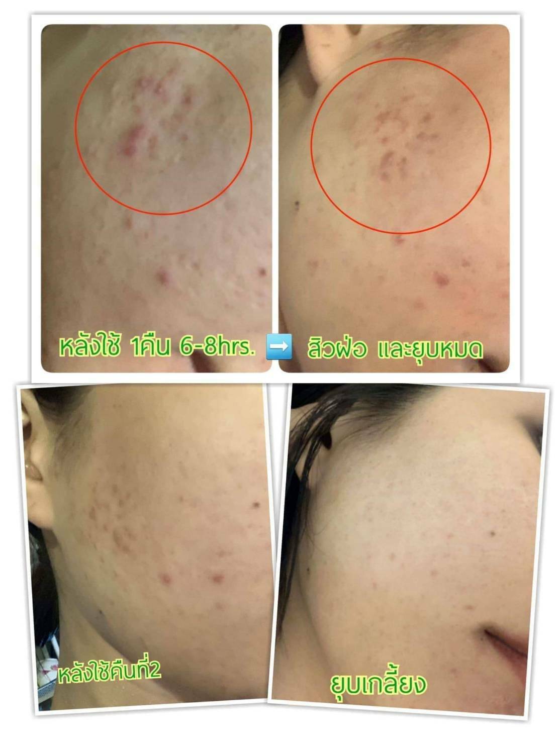 SOS Skin Hydrate Acne+ เซรั่มลดการอักเสบของสิว หน้าใสไร้สิว 20 g.