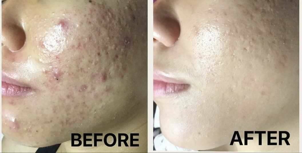 SOS Skin Hydrate Acne+ เซรั่มลดการอักเสบของสิว หน้าใสไร้สิว 20 g.