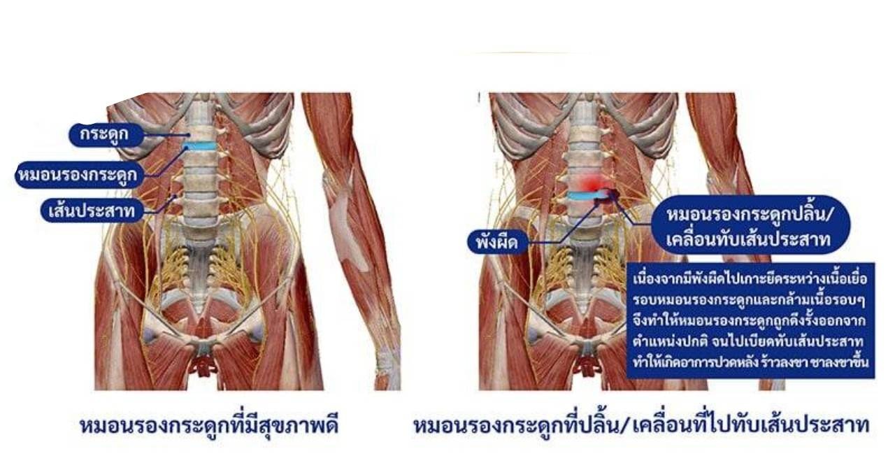 1 hrs Massage catching / นวดจับเส้น 👍นวดแก้อาการ 📌นวดจับเส้น 📌เอ็นเข้าสะบัก📌ไหล่ติด📌ปวดหลัง📌ชา📌ปวดขา📌ปวดสลักเพชร📌ท้องอืด📌ไมเกรน📌คอตกหมอน 📌หมอนรองกระดูกทับเส้นป