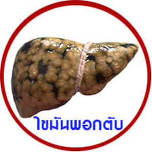 ไขมันพอกตับ ไขมันเกาะตับ ไขมันแทรกตับ