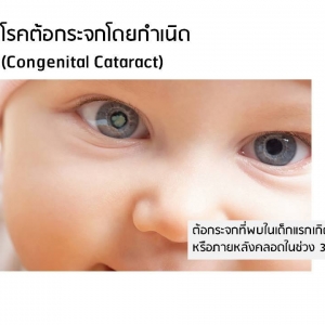"สาระความรู้กับ Kidzonia Eyewear" โรคต้อกระจกโดยกำเนิด (Congenitial Cataract)