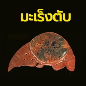 มะเร็งตับ